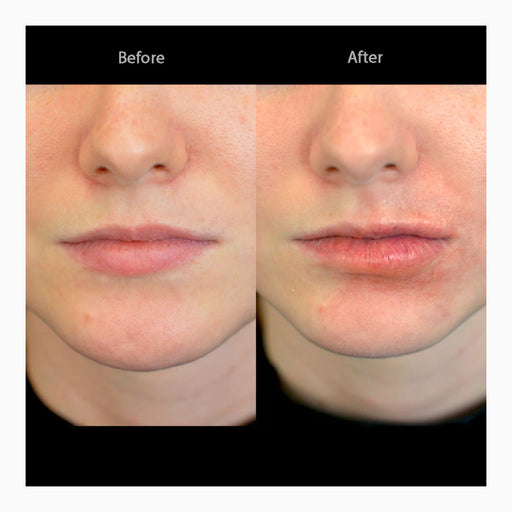 Out of Kit Subtle Swollen Lips before and after finished application side-by-side. 