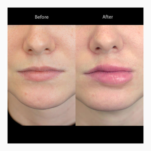 Out of Kit Swollen Lips 2 before and after finished application side-by-side