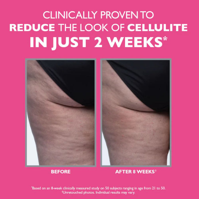 Peter Thomas Roth FirmX Tight & Toned Cellulite Treatment before and after *2 weeks difference