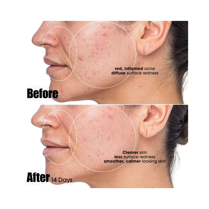 Sunday Riley Peace Keeper Acne Treatment Serum