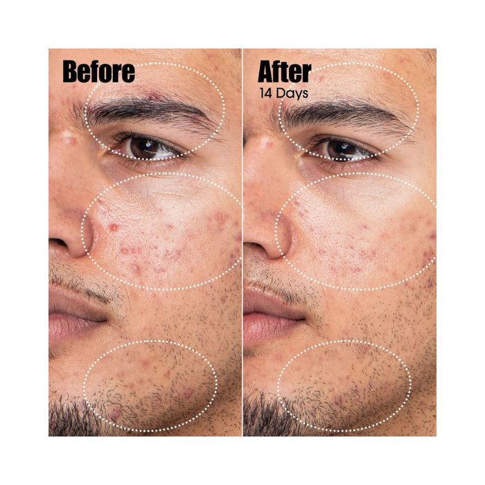 Sunday Riley Peace Keeper Acne Treatment Serum