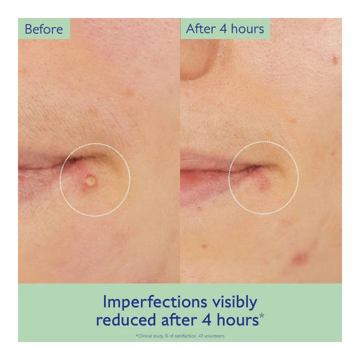 Caudalie Vinopure Targeted Salicylic Solution Before and After side-by-side 4 hours post application